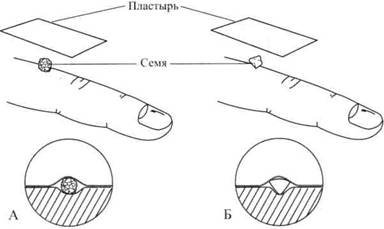 Су Джок семянотерапия